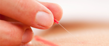 Acupuncture Acupuncture